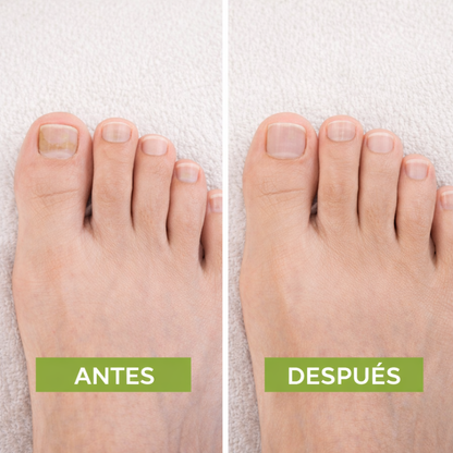 PARCHE ANTI HONGO™